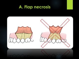 Flap Design for Minor Oral Surgery | PDF
