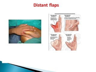 Slow Flap Flap and its classification | PPTX