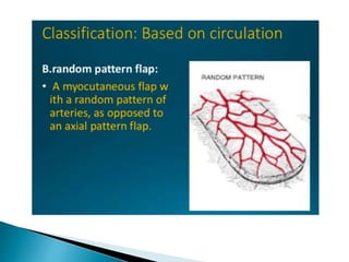 Flap and its classification | PPTX