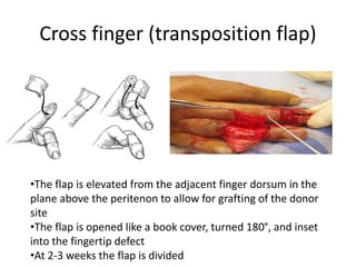 Cross finger (transposition flap)
•The flap is elevated from the adjacent finger dorsum in the
plane above the peritenon to allow for grafting of the donor
site
•The flap is opened like a book cover, turned 180°, and inset
into the fingertip defect
•At 2-3 weeks the flap is divided
 