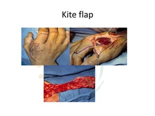 Kite flap
 