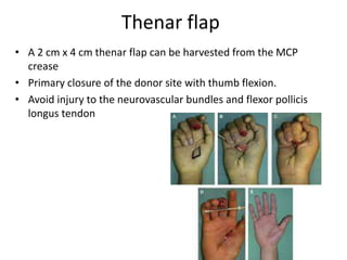 Thenar flap
• A 2 cm x 4 cm thenar flap can be harvested from the MCP
crease
• Primary closure of the donor site with thumb flexion.
• Avoid injury to the neurovascular bundles and flexor pollicis
longus tendon
 