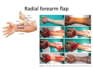 Radial forearm flap
 