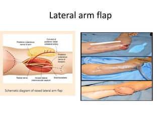 Lateral arm flap
 