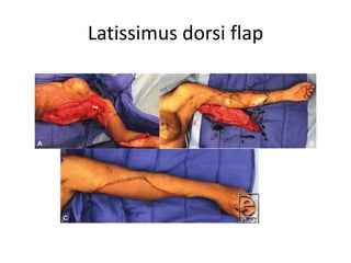 Latissimus dorsi flap
 