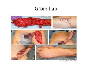 Groin flap
 