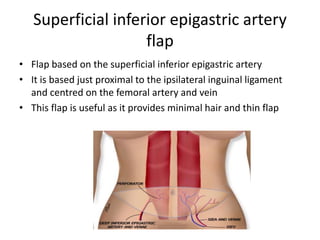 Superficial inferior epigastric artery
flap
• Flap based on the superficial inferior epigastric artery
• It is based just proximal to the ipsilateral inguinal ligament
and centred on the femoral artery and vein
• This flap is useful as it provides minimal hair and thin flap
 