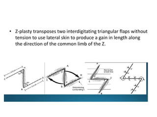 • Z-plasty transposes two interdigitating triangular flaps without
tension to use lateral skin to produce a gain in length along
the direction of the common limb of the Z.
 