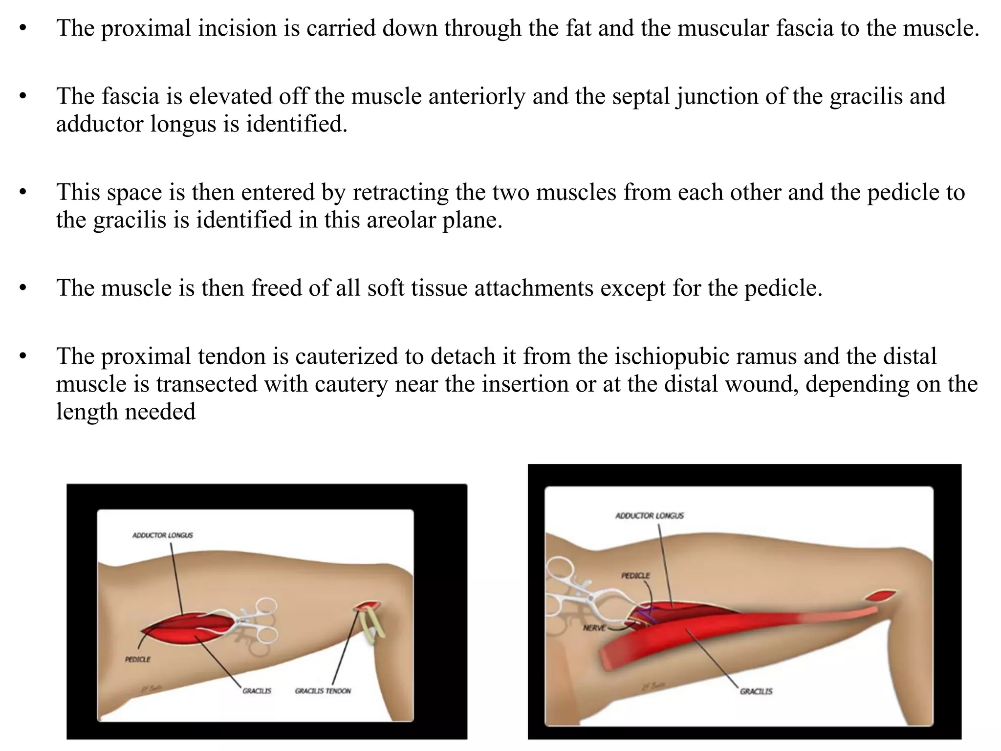 • The proximal incision is carried down through the fat and the muscular fascia to the muscle.
• The fascia is elevated off the muscle anteriorly and the septal junction of the gracilis and
adductor longus is identified.
• This space is then entered by retracting the two muscles from each other and the pedicle to
the gracilis is identified in this areolar plane.
• The muscle is then freed of all soft tissue attachments except for the pedicle.
• The proximal tendon is cauterized to detach it from the ischiopubic ramus and the distal
muscle is transected with cautery near the insertion or at the distal wound, depending on the
length needed
 