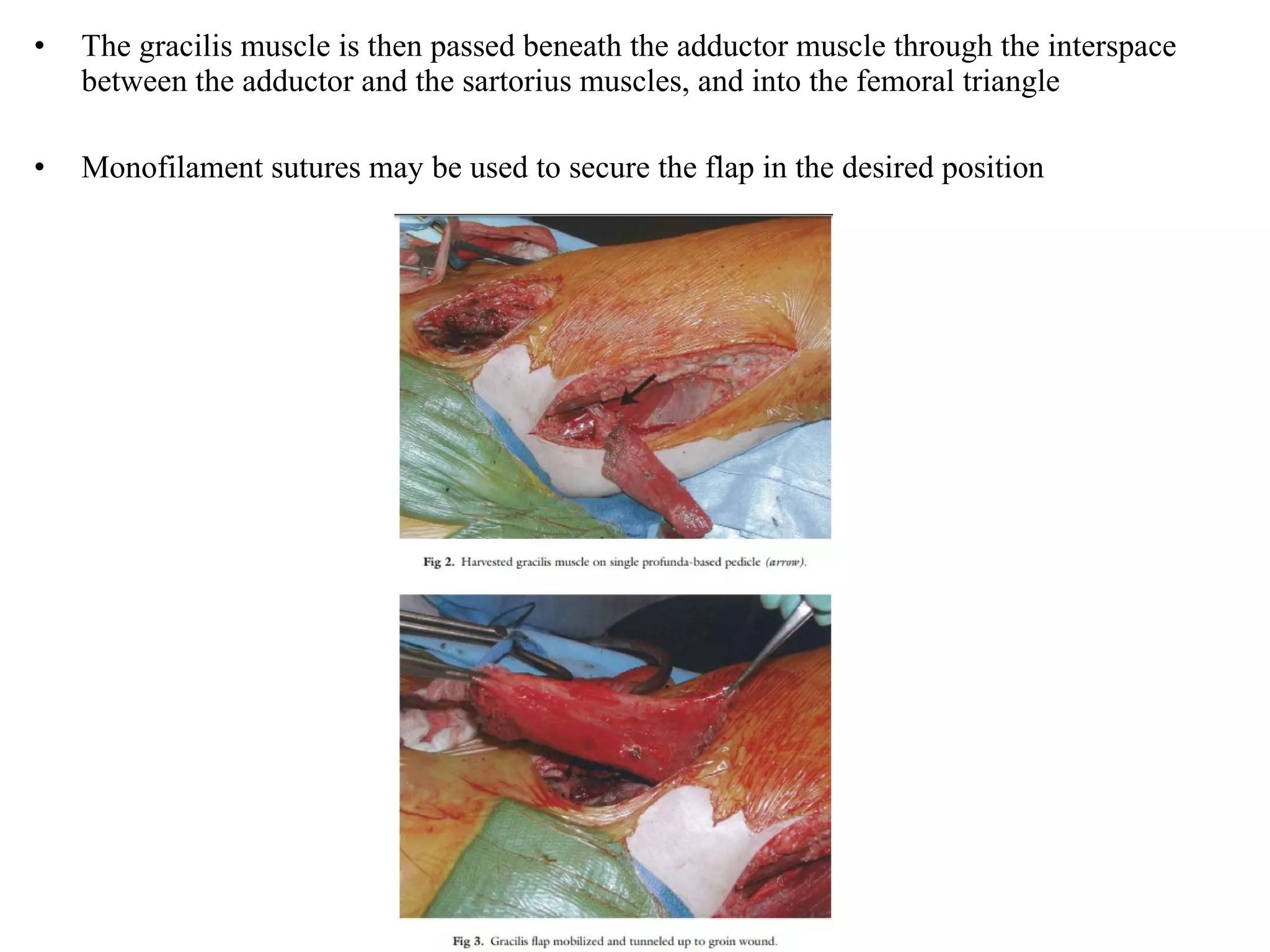 • The gracilis muscle is then passed beneath the adductor muscle through the interspace
between the adductor and the sartorius muscles, and into the femoral triangle
• Monofilament sutures may be used to secure the flap in the desired position
 