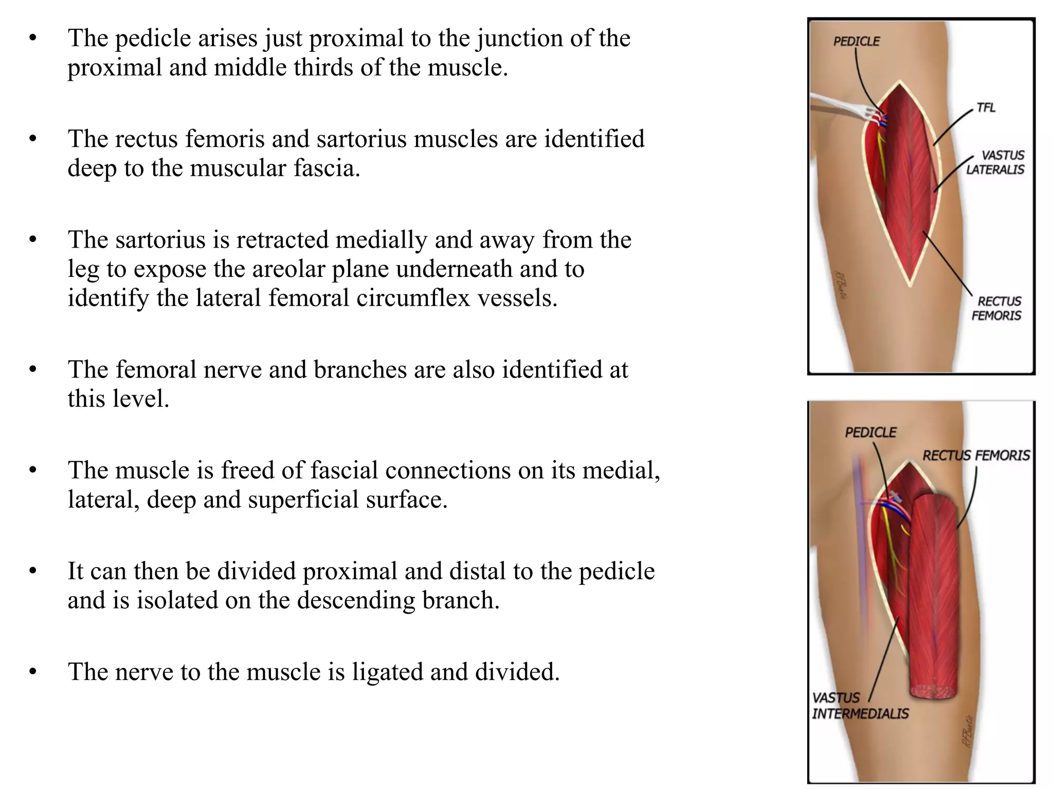• The pedicle arises just proximal to the junction of the
proximal and middle thirds of the muscle.
• The rectus femoris and sartorius muscles are identified
deep to the muscular fascia.
• The sartorius is retracted medially and away from the
leg to expose the areolar plane underneath and to
identify the lateral femoral circumflex vessels.
• The femoral nerve and branches are also identified at
this level.
• The muscle is freed of fascial connections on its medial,
lateral, deep and superficial surface.
• It can then be divided proximal and distal to the pedicle
and is isolated on the descending branch.
• The nerve to the muscle is ligated and divided.
 