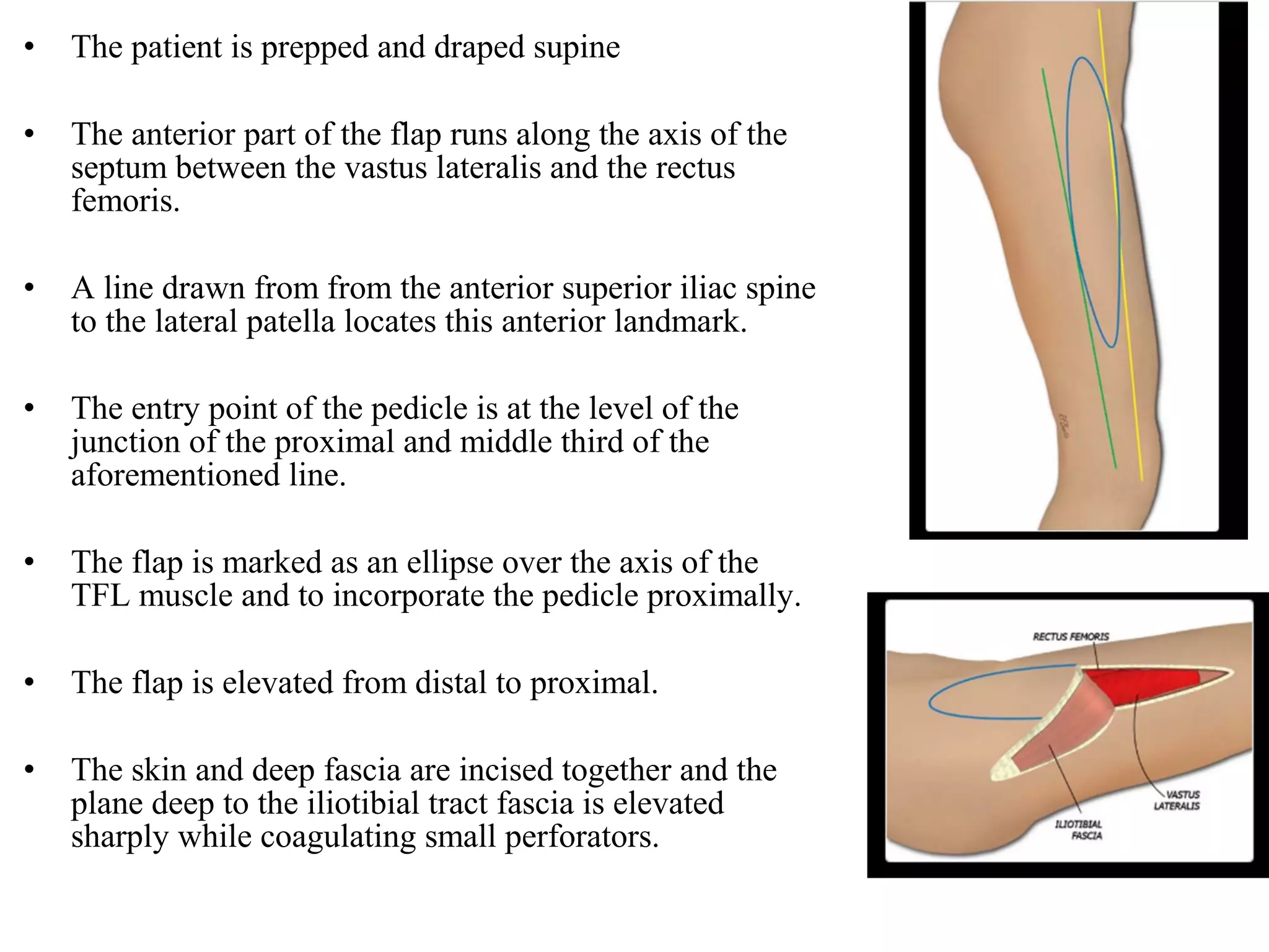 • The patient is prepped and draped supine
• The anterior part of the flap runs along the axis of the
septum between the vastus lateralis and the rectus
femoris.
• A line drawn from from the anterior superior iliac spine
to the lateral patella locates this anterior landmark.
• The entry point of the pedicle is at the level of the
junction of the proximal and middle third of the
aforementioned line.
• The flap is marked as an ellipse over the axis of the
TFL muscle and to incorporate the pedicle proximally.
• The flap is elevated from distal to proximal.
• The skin and deep fascia are incised together and the
plane deep to the iliotibial tract fascia is elevated
sharply while coagulating small perforators.
 