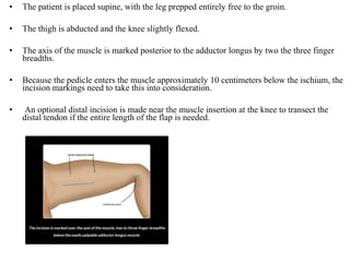 • The patient is placed supine, with the leg prepped entirely free to the groin.
• The thigh is abducted and the knee slightly flexed.
• The axis of the muscle is marked posterior to the adductor longus by two the three finger
breadths.
• Because the pedicle enters the muscle approximately 10 centimeters below the ischium, the
incision markings need to take this into consideration.
• An optional distal incision is made near the muscle insertion at the knee to transect the
distal tendon if the entire length of the flap is needed.
 