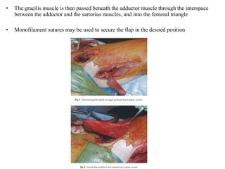 • The gracilis muscle is then passed beneath the adductor muscle through the interspace
between the adductor and the sartorius muscles, and into the femoral triangle
• Monofilament sutures may be used to secure the flap in the desired position
 
