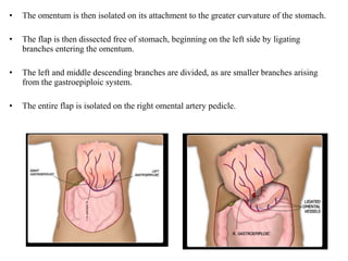 • The omentum is then isolated on its attachment to the greater curvature of the stomach.
• The flap is then dissected free of stomach, beginning on the left side by ligating
branches entering the omentum.
• The left and middle descending branches are divided, as are smaller branches arising
from the gastroepiploic system.
• The entire flap is isolated on the right omental artery pedicle.
 