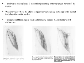 • The sartorius muscle fascia is incised longitudinally up to the tendon portion of the
muscle
• With sharp dissection, the lateral and posterior surfaces are mobilized up to, but not
including, the medial border.
• The segmental blood supply entering the muscle from its medial border is left
undissected.
 