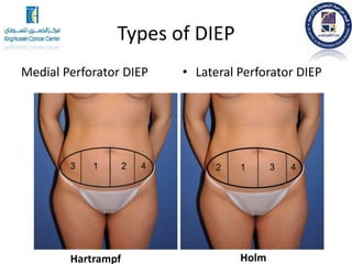 Types of DIEP
Medial Perforator DIEP • Lateral Perforator DIEP
Hartrampf Holm
 