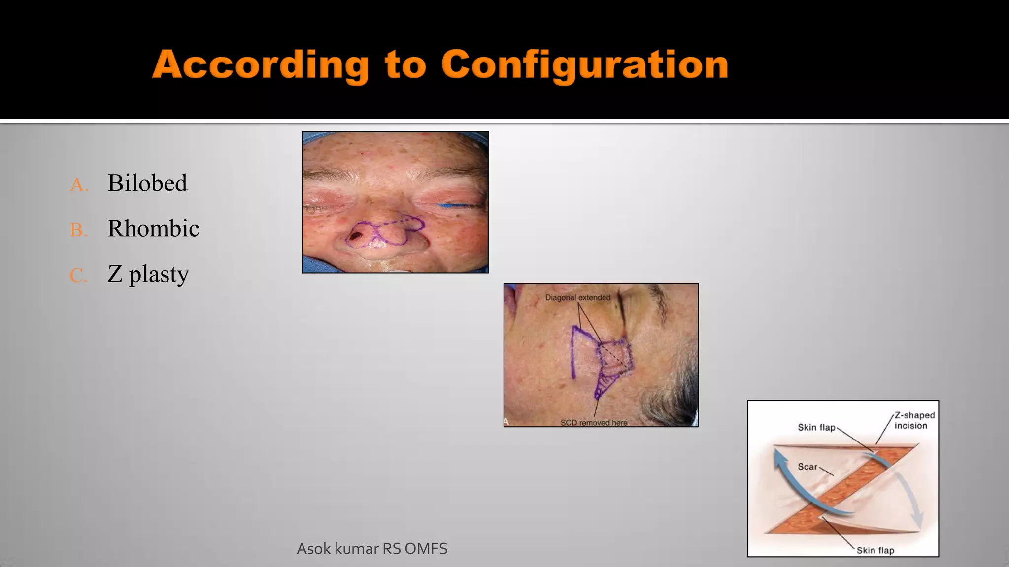 A. Bilobed
B. Rhombic
C. Z plasty
Asok kumar RS OMFS
 