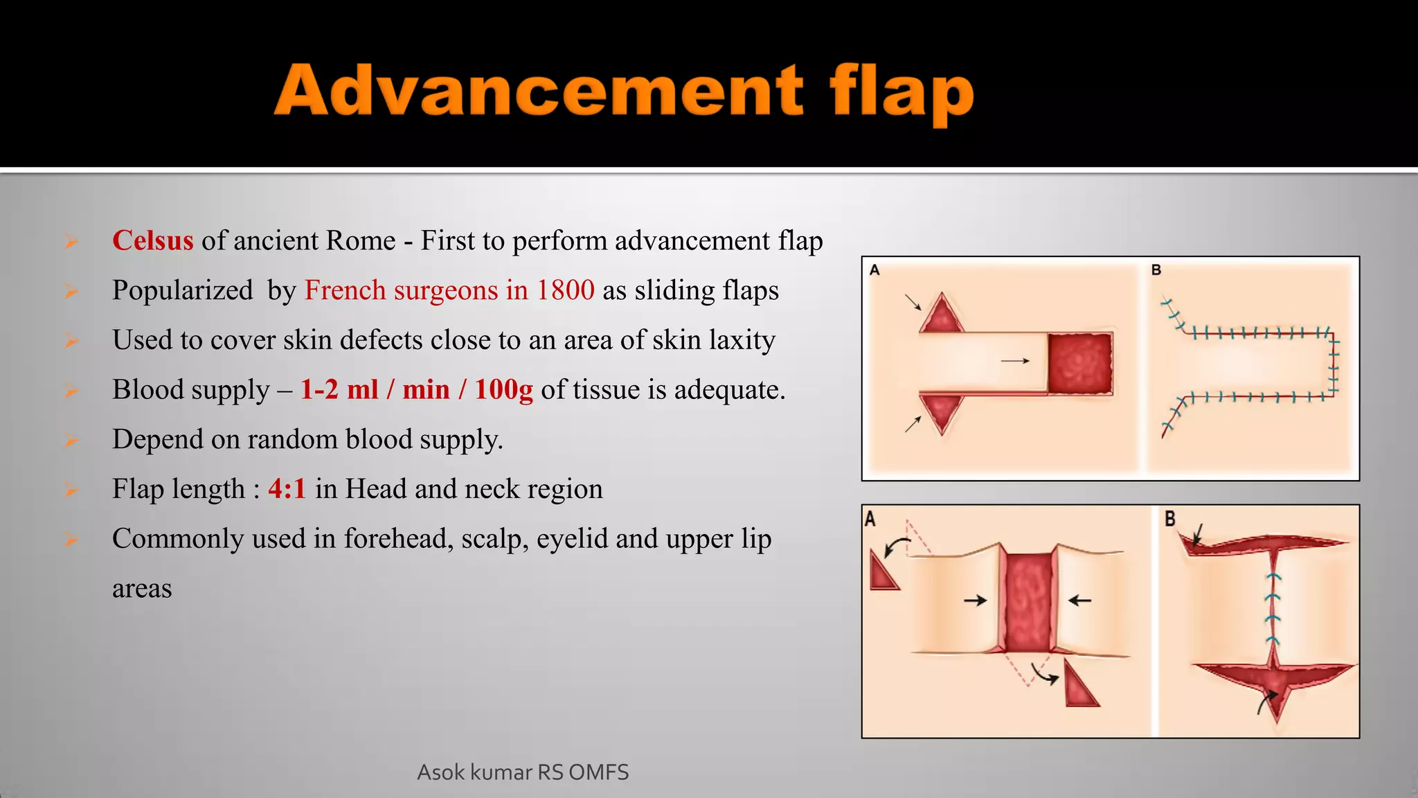  Celsus of ancient Rome - First to perform advancement flap
 Popularized by French surgeons in 1800 as sliding flaps
 Used to cover skin defects close to an area of skin laxity
 Blood supply – 1-2 ml / min / 100g of tissue is adequate.
 Depend on random blood supply.
 Flap length : 4:1 in Head and neck region
 Commonly used in forehead, scalp, eyelid and upper lip
areas
Asok kumar RS OMFS
 