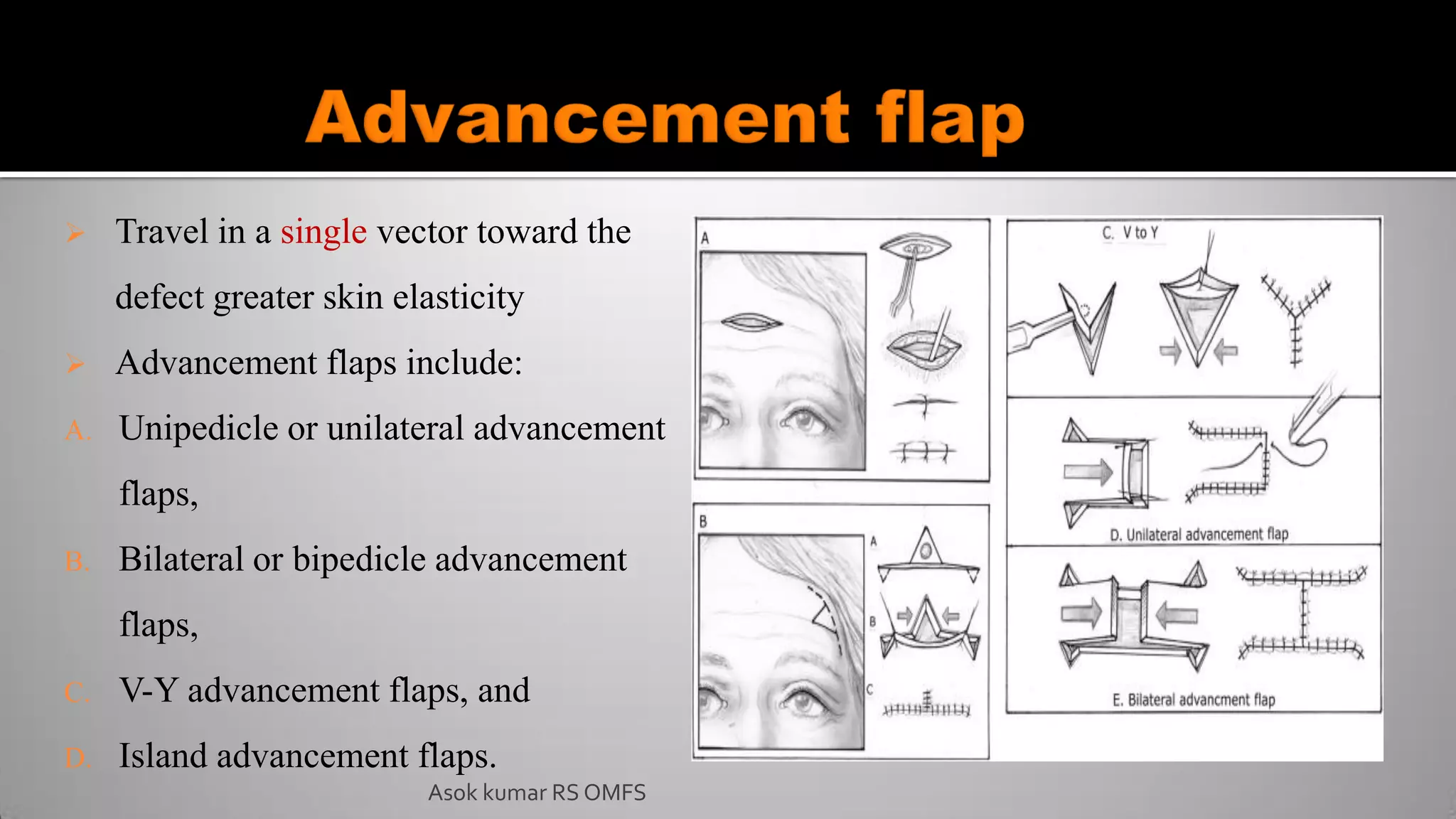  Travel in a single vector toward the
defect greater skin elasticity
 Advancement flaps include:
A. Unipedicle or unilateral advancement
flaps,
B. Bilateral or bipedicle advancement
flaps,
C. V-Y advancement flaps, and
D. Island advancement flaps.
Asok kumar RS OMFS
 