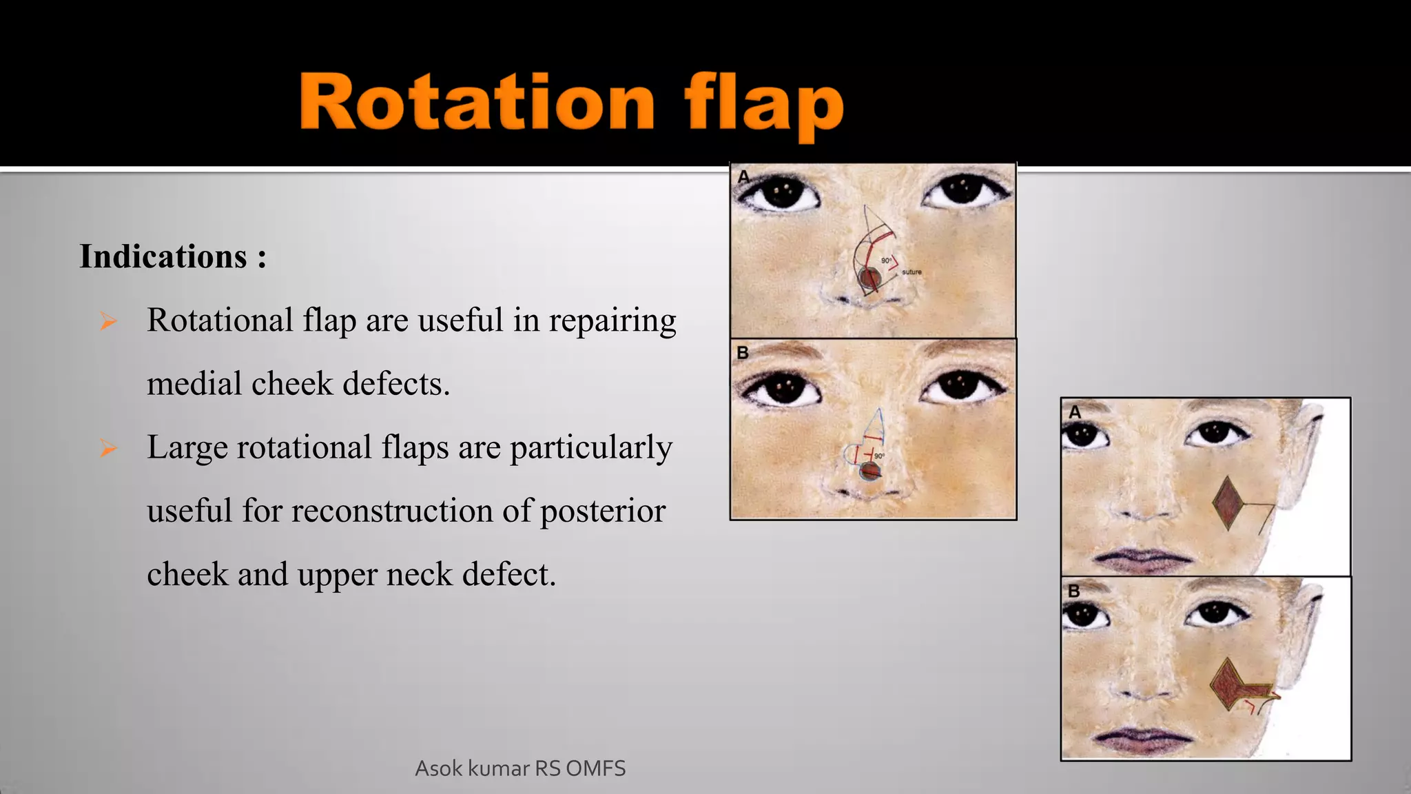 Asok kumar RS OMFS
Indications :
 Rotational flap are useful in repairing
medial cheek defects.
 Large rotational flaps are particularly
useful for reconstruction of posterior
cheek and upper neck defect.
 
