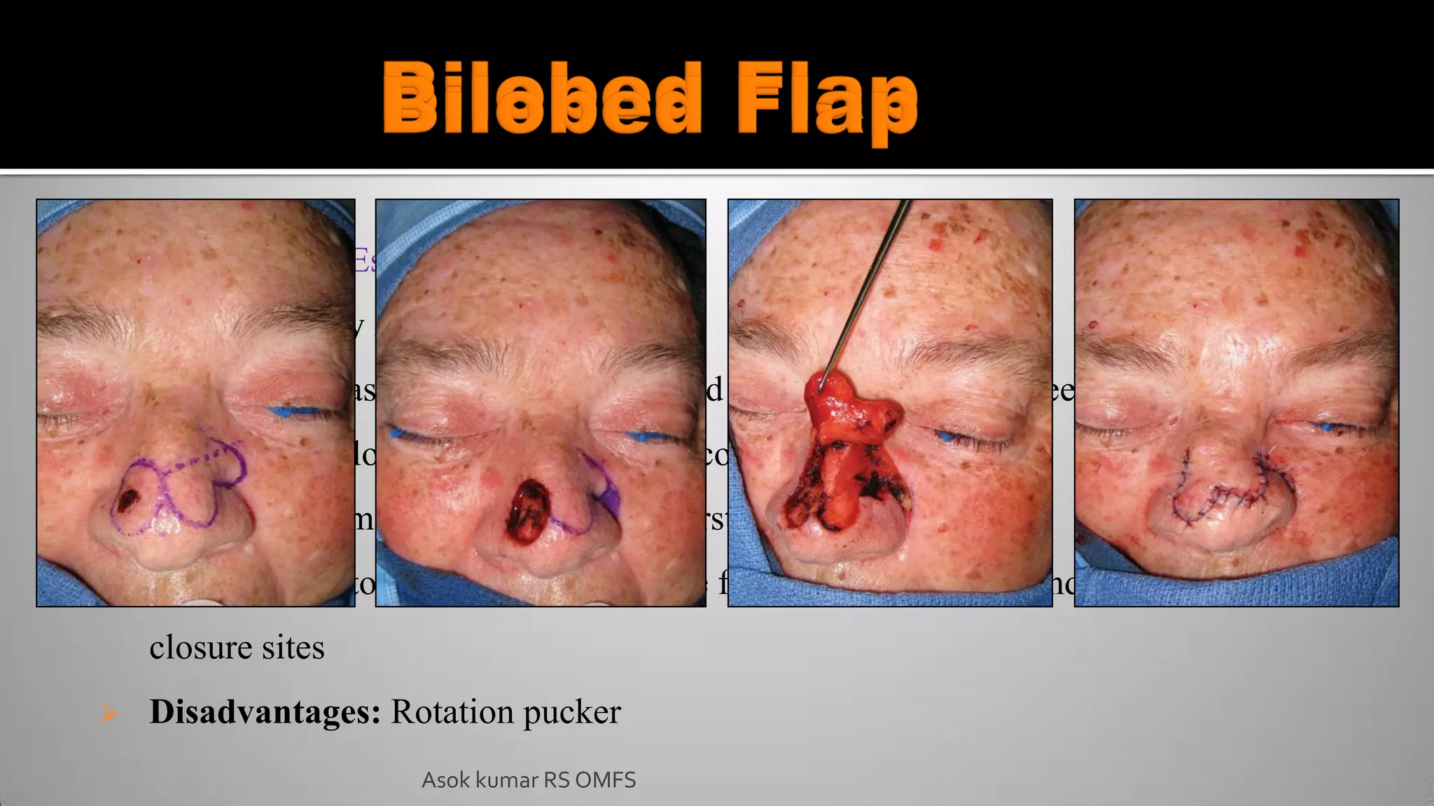  Described by Esser (1918)
 Popularized by Zimany
 Reconstruct nasal and facial defects and even full thickness cheek defects.
 Tension free closure of original and secondary defects.
 90º is the optimal angle between the first and second flap
 Maximum distortion occurs around the flap bases and the second donor lobe
closure sites
 Disadvantages: Rotation pucker
Asok kumar RS OMFS
 