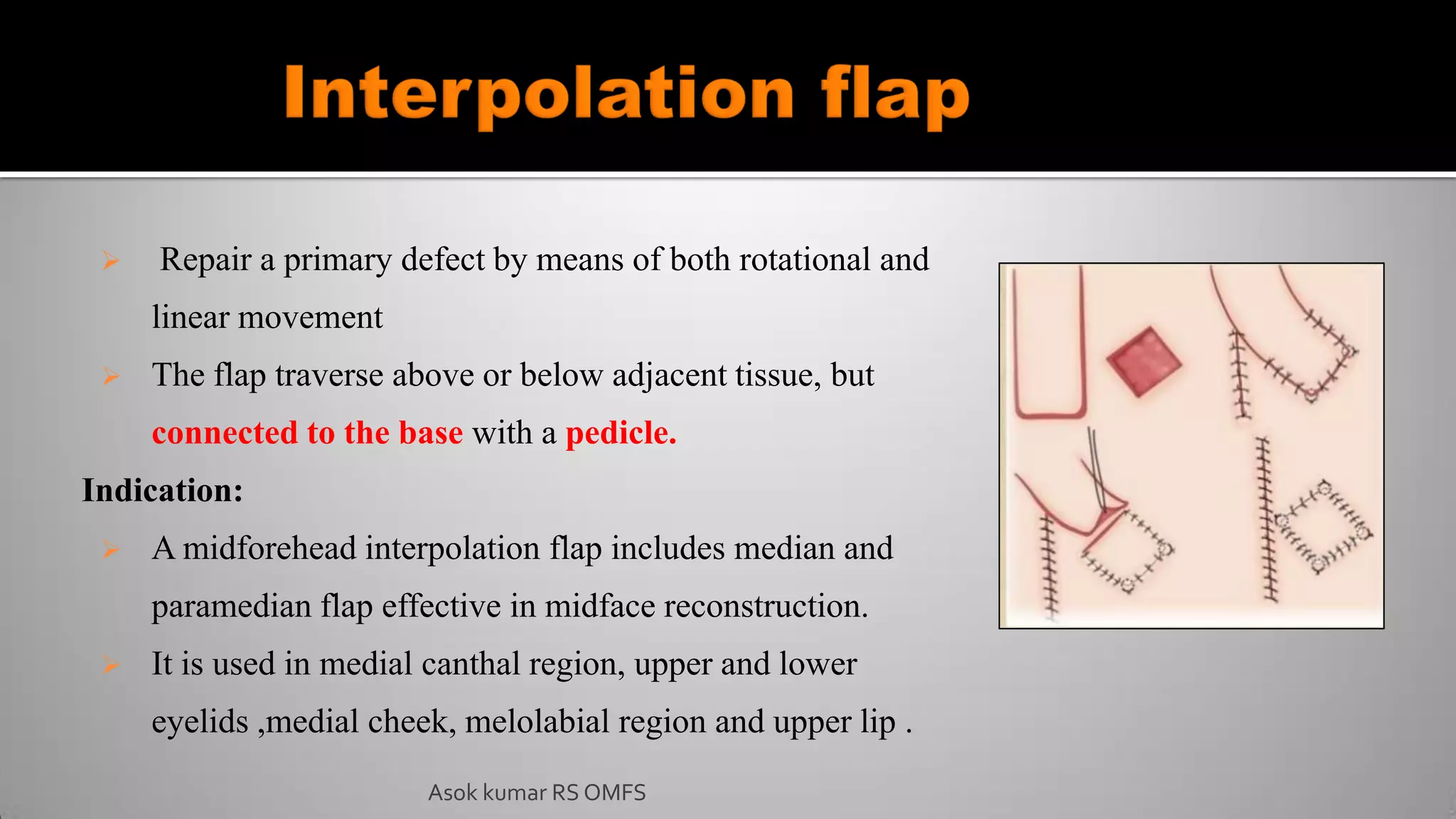  Repair a primary defect by means of both rotational and
linear movement
 The flap traverse above or below adjacent tissue, but
connected to the base with a pedicle.
Indication:
 A midforehead interpolation flap includes median and
paramedian flap effective in midface reconstruction.
 It is used in medial canthal region, upper and lower
eyelids ,medial cheek, melolabial region and upper lip .
Asok kumar RS OMFS
 