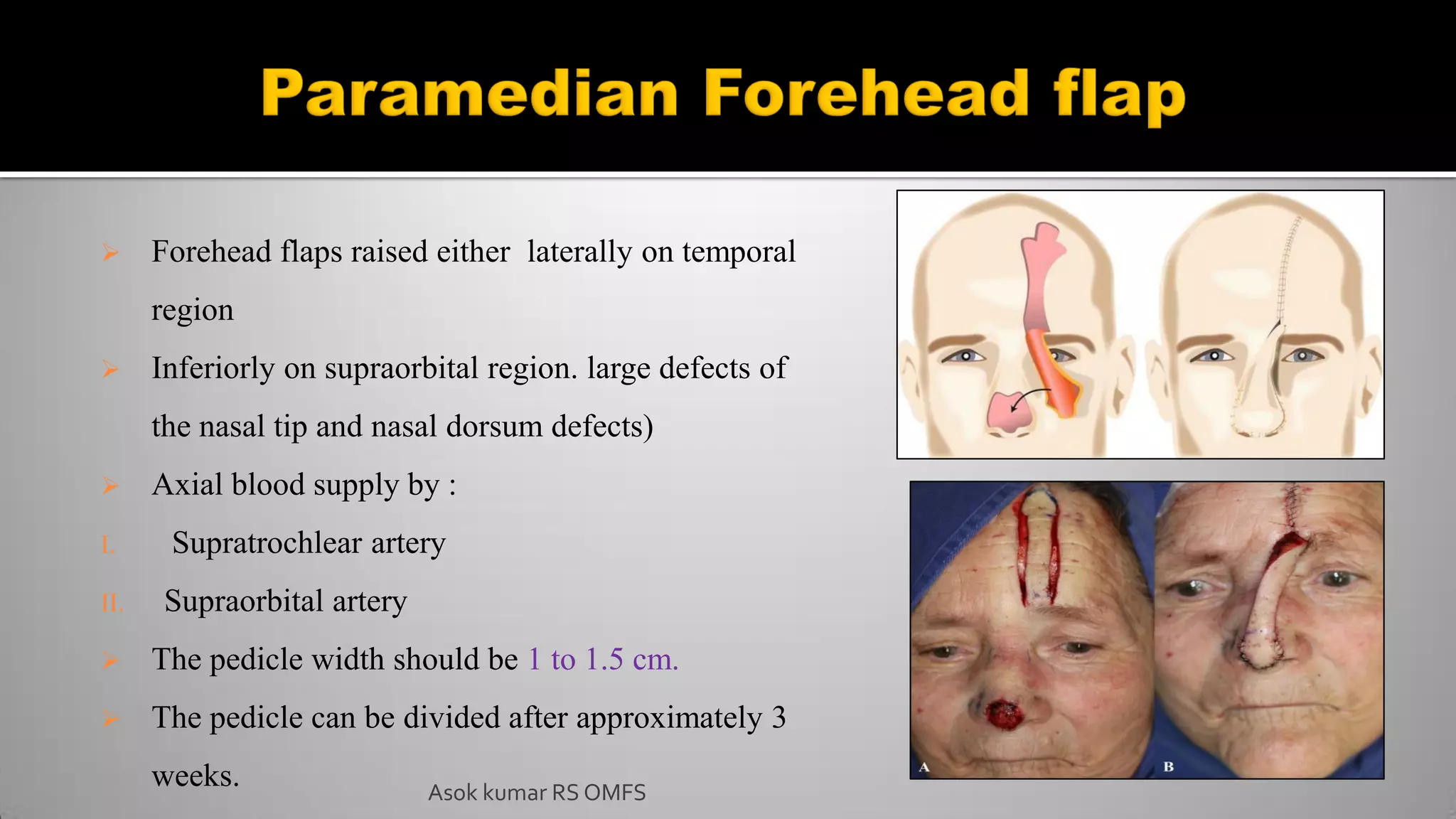  Forehead flaps raised either laterally on temporal
region
 Inferiorly on supraorbital region. large defects of
the nasal tip and nasal dorsum defects)
 Axial blood supply by :
I. Supratrochlear artery
II. Supraorbital artery
 The pedicle width should be 1 to 1.5 cm.
 The pedicle can be divided after approximately 3
weeks. Asok kumar RS OMFS
 