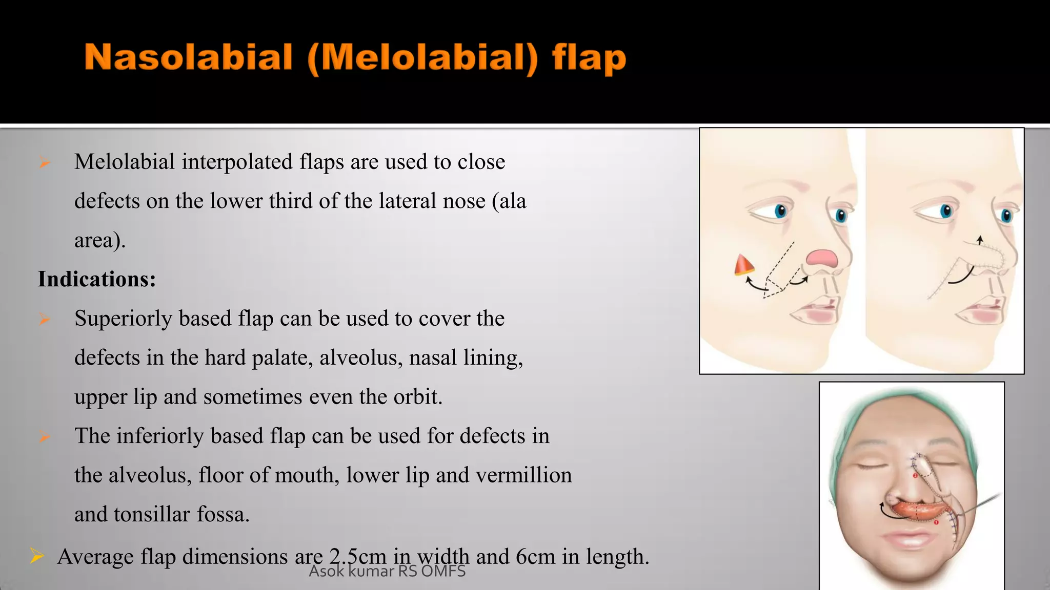  Melolabial interpolated flaps are used to close
defects on the lower third of the lateral nose (ala
area).
Indications:
 Superiorly based flap can be used to cover the
defects in the hard palate, alveolus, nasal lining,
upper lip and sometimes even the orbit.
 The inferiorly based flap can be used for defects in
the alveolus, floor of mouth, lower lip and vermillion
and tonsillar fossa.
 Average flap dimensions are 2.5cm in width and 6cm in length.
Asok kumar RS OMFS
 