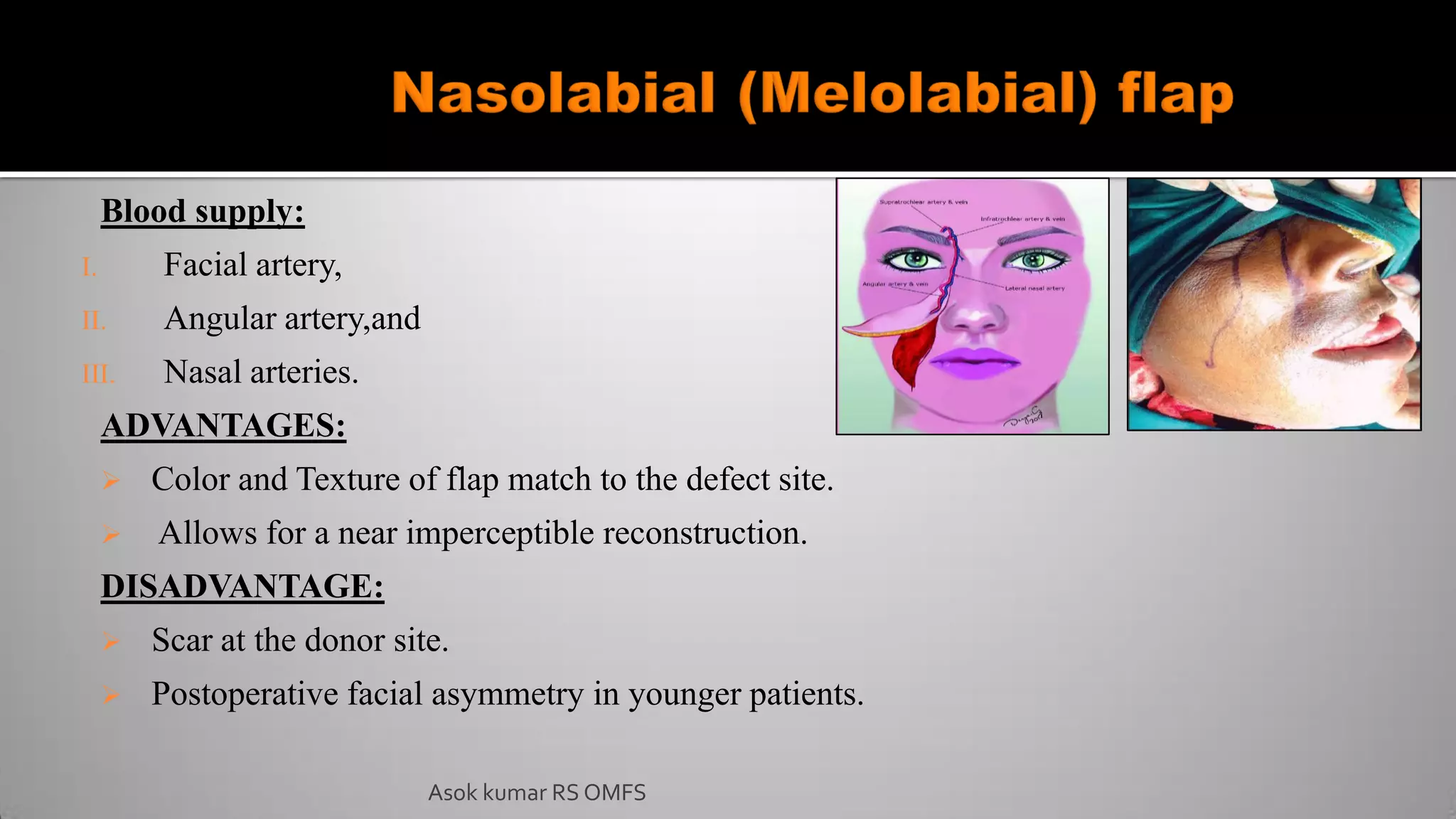 Asok kumar RS OMFS
Blood supply:
I. Facial artery,
II. Angular artery,and
III. Nasal arteries.
ADVANTAGES:
 Color and Texture of flap match to the defect site.
 Allows for a near imperceptible reconstruction.
DISADVANTAGE:
 Scar at the donor site.
 Postoperative facial asymmetry in younger patients.
 