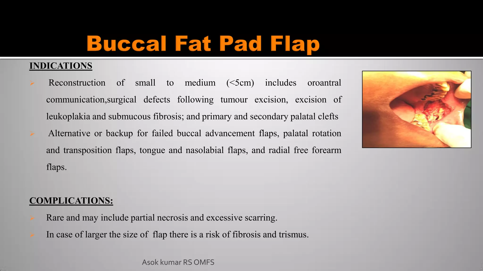 Asok kumar RS OMFS
INDICATIONS
 Reconstruction of small to medium (<5cm) includes oroantral
communication,surgical defects following tumour excision, excision of
leukoplakia and submucous fibrosis; and primary and secondary palatal clefts
 Alternative or backup for failed buccal advancement flaps, palatal rotation
and transposition flaps, tongue and nasolabial flaps, and radial free forearm
flaps.
COMPLICATIONS:
 Rare and may include partial necrosis and excessive scarring.
 In case of larger the size of flap there is a risk of fibrosis and trismus.
 