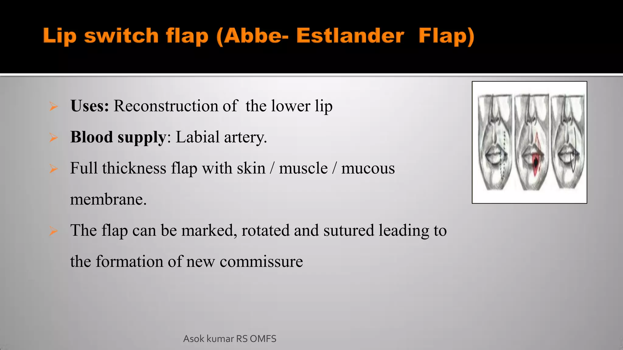  Uses: Reconstruction of the lower lip
 Blood supply: Labial artery.
 Full thickness flap with skin / muscle / mucous
membrane.
 The flap can be marked, rotated and sutured leading to
the formation of new commissure
Asok kumar RS OMFS
 