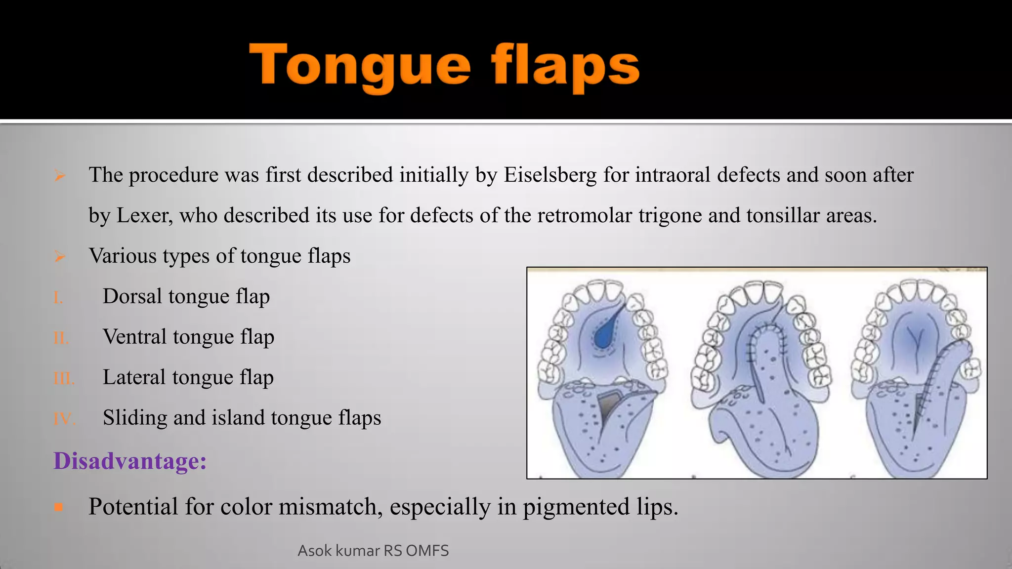  The procedure was first described initially by Eiselsberg for intraoral defects and soon after
by Lexer, who described its use for defects of the retromolar trigone and tonsillar areas.
 Various types of tongue flaps
I. Dorsal tongue flap
II. Ventral tongue flap
III. Lateral tongue flap
IV. Sliding and island tongue flaps
Disadvantage:
 Potential for color mismatch, especially in pigmented lips.
Asok kumar RS OMFS
 