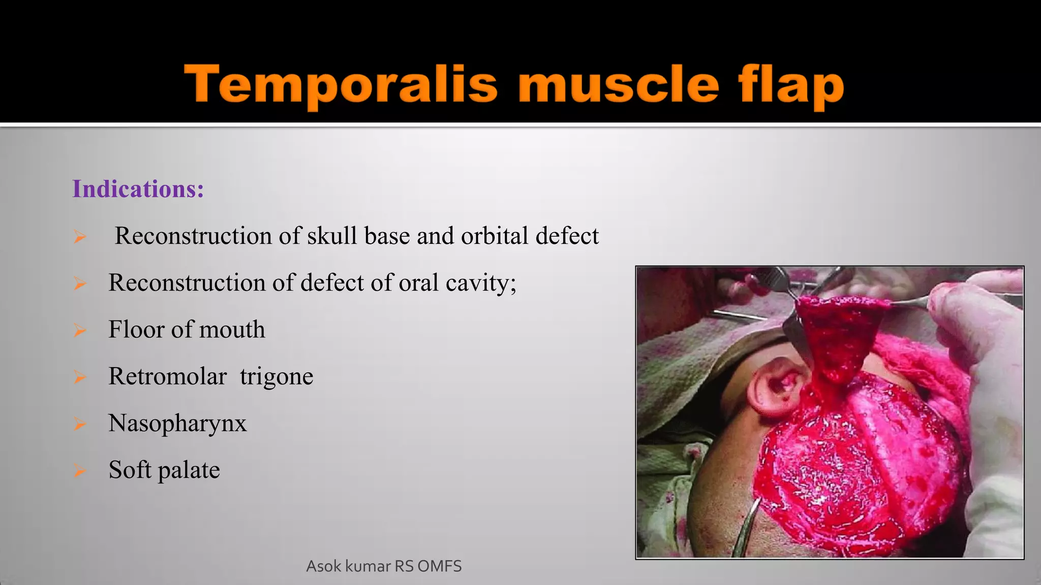Indications:
 Reconstruction of skull base and orbital defect
 Reconstruction of defect of oral cavity;
 Floor of mouth
 Retromolar trigone
 Nasopharynx
 Soft palate
Asok kumar RS OMFS
 