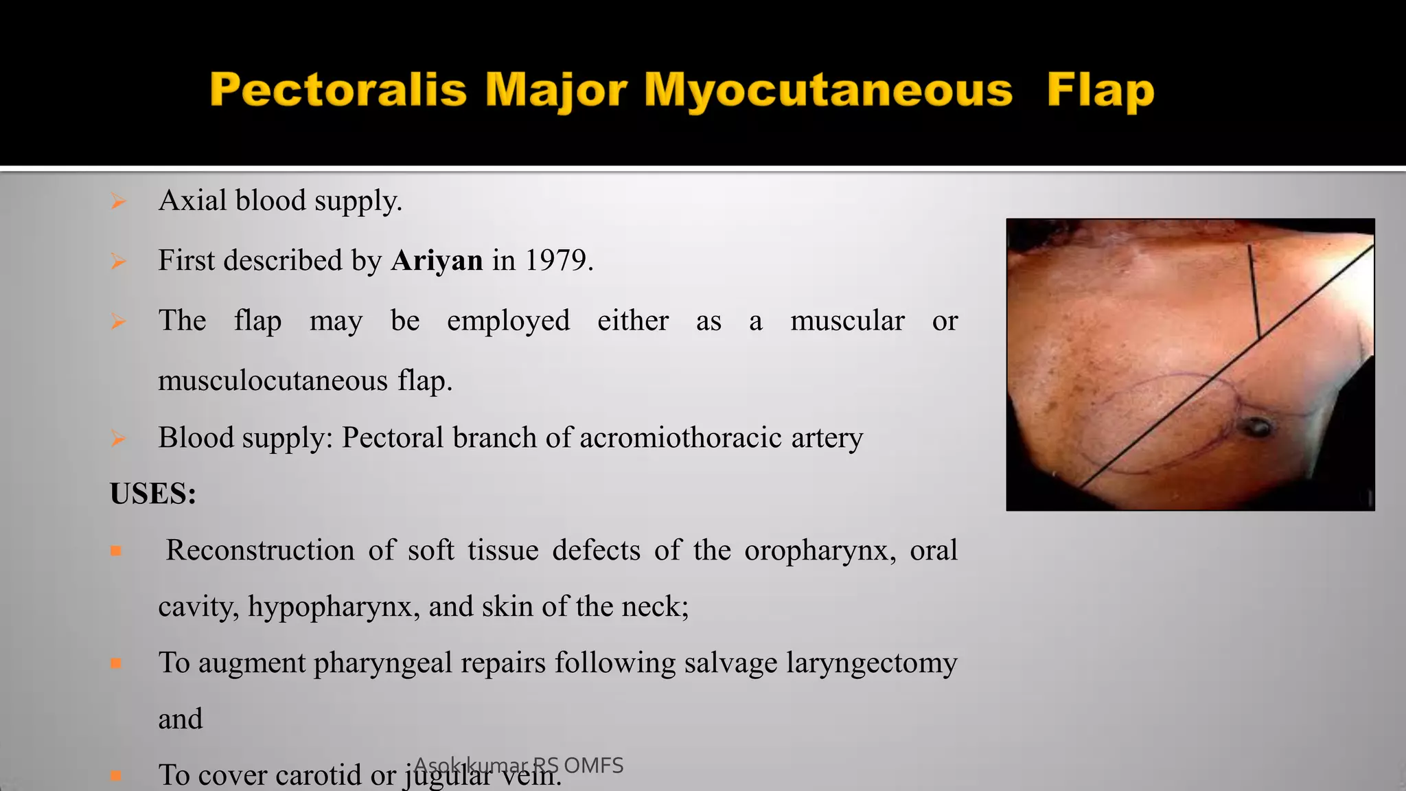  Axial blood supply.
 First described by Ariyan in 1979.
 The flap may be employed either as a muscular or
musculocutaneous flap.
 Blood supply: Pectoral branch of acromiothoracic artery
USES:
 Reconstruction of soft tissue defects of the oropharynx, oral
cavity, hypopharynx, and skin of the neck;
 To augment pharyngeal repairs following salvage laryngectomy
and
 To cover carotid or jugular vein.
Asok kumar RS OMFS
 