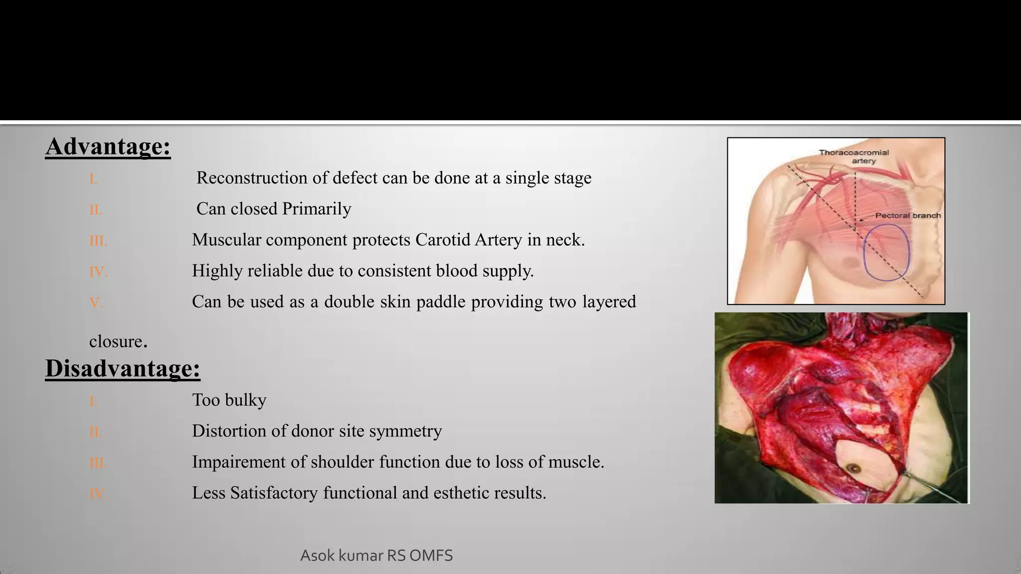 Asok kumar RS OMFS
Advantage:
I. Reconstruction of defect can be done at a single stage
II. Can closed Primarily
III. Muscular component protects Carotid Artery in neck.
IV. Highly reliable due to consistent blood supply.
V. Can be used as a double skin paddle providing two layered
closure.
Disadvantage:
I. Too bulky
II. Distortion of donor site symmetry
III. Impairement of shoulder function due to loss of muscle.
IV. Less Satisfactory functional and esthetic results.
 