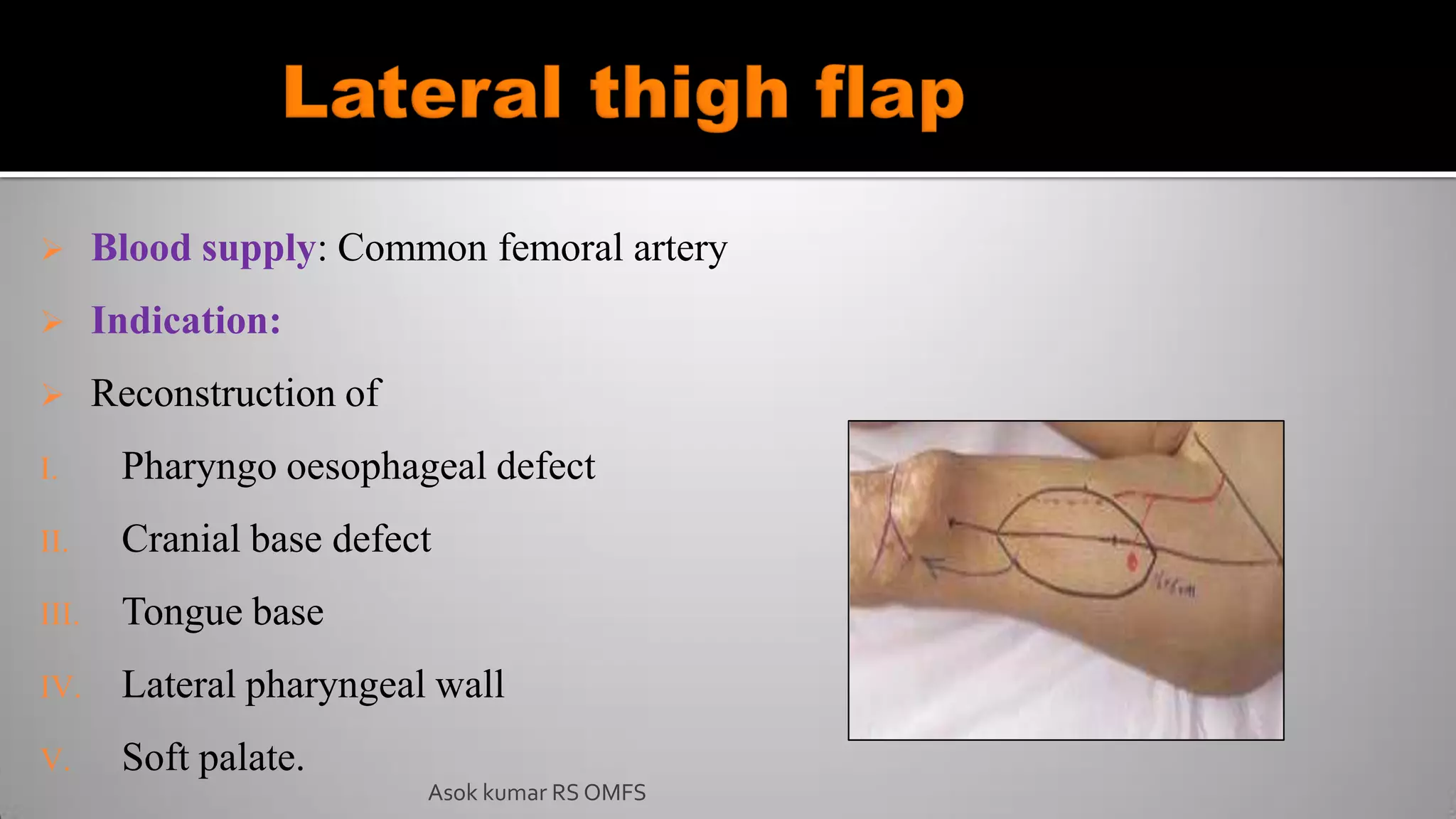  Blood supply: Common femoral artery
 Indication:
 Reconstruction of
I. Pharyngo oesophageal defect
II. Cranial base defect
III. Tongue base
IV. Lateral pharyngeal wall
V. Soft palate.
Asok kumar RS OMFS
 