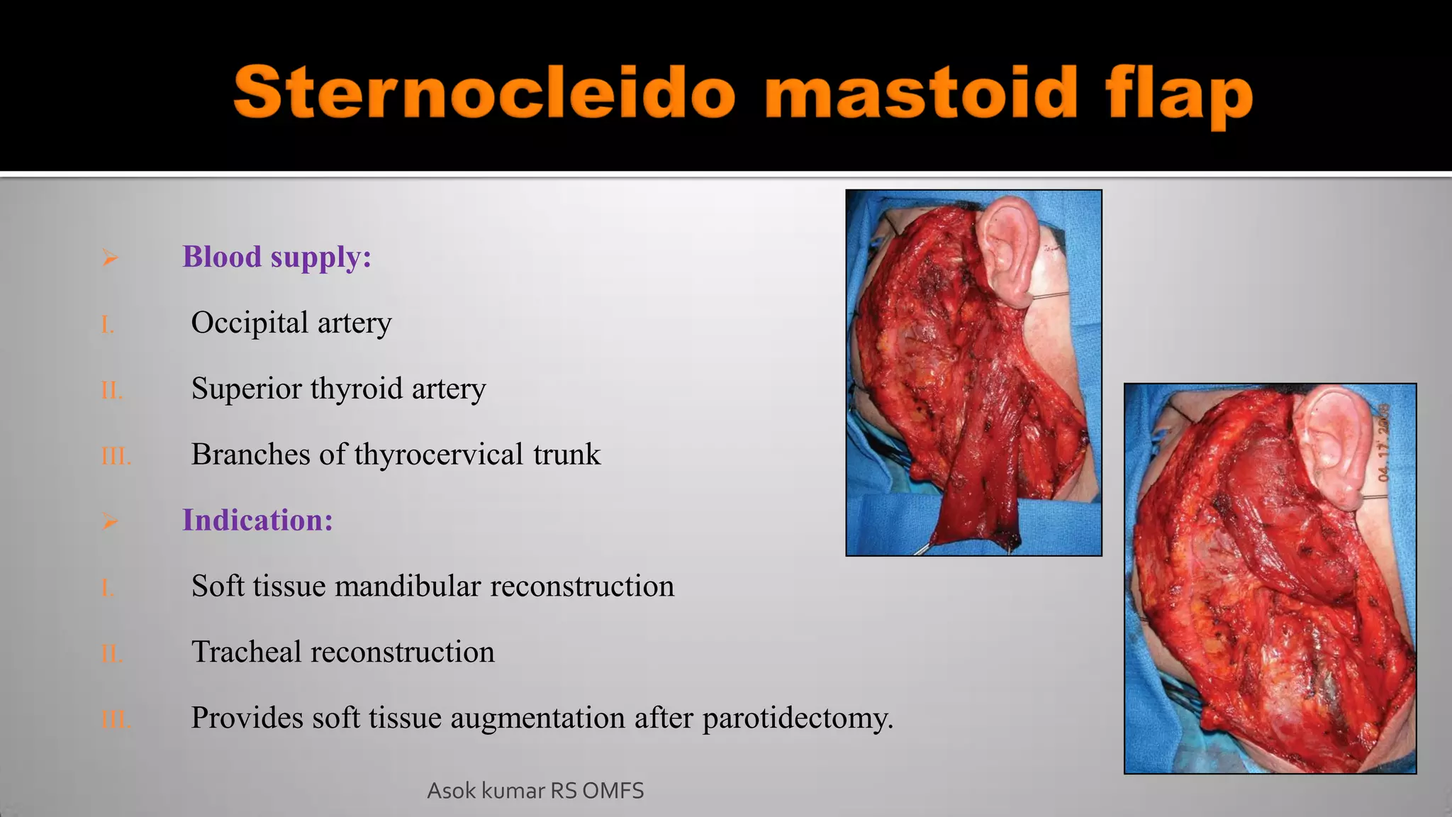 Blood supply:
I. Occipital artery
II. Superior thyroid artery
III. Branches of thyrocervical trunk
 Indication:
I. Soft tissue mandibular reconstruction
II. Tracheal reconstruction
III. Provides soft tissue augmentation after parotidectomy.
Asok kumar RS OMFS
 