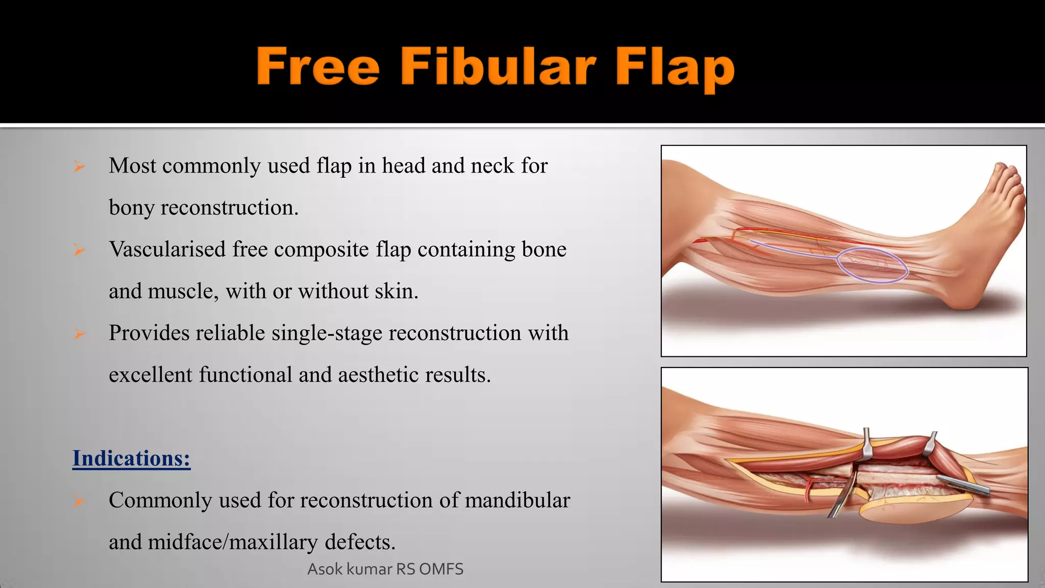  Most commonly used flap in head and neck for
bony reconstruction.
 Vascularised free composite flap containing bone
and muscle, with or without skin.
 Provides reliable single-stage reconstruction with
excellent functional and aesthetic results.
Indications:
 Commonly used for reconstruction of mandibular
and midface/maxillary defects.
Asok kumar RS OMFS
 