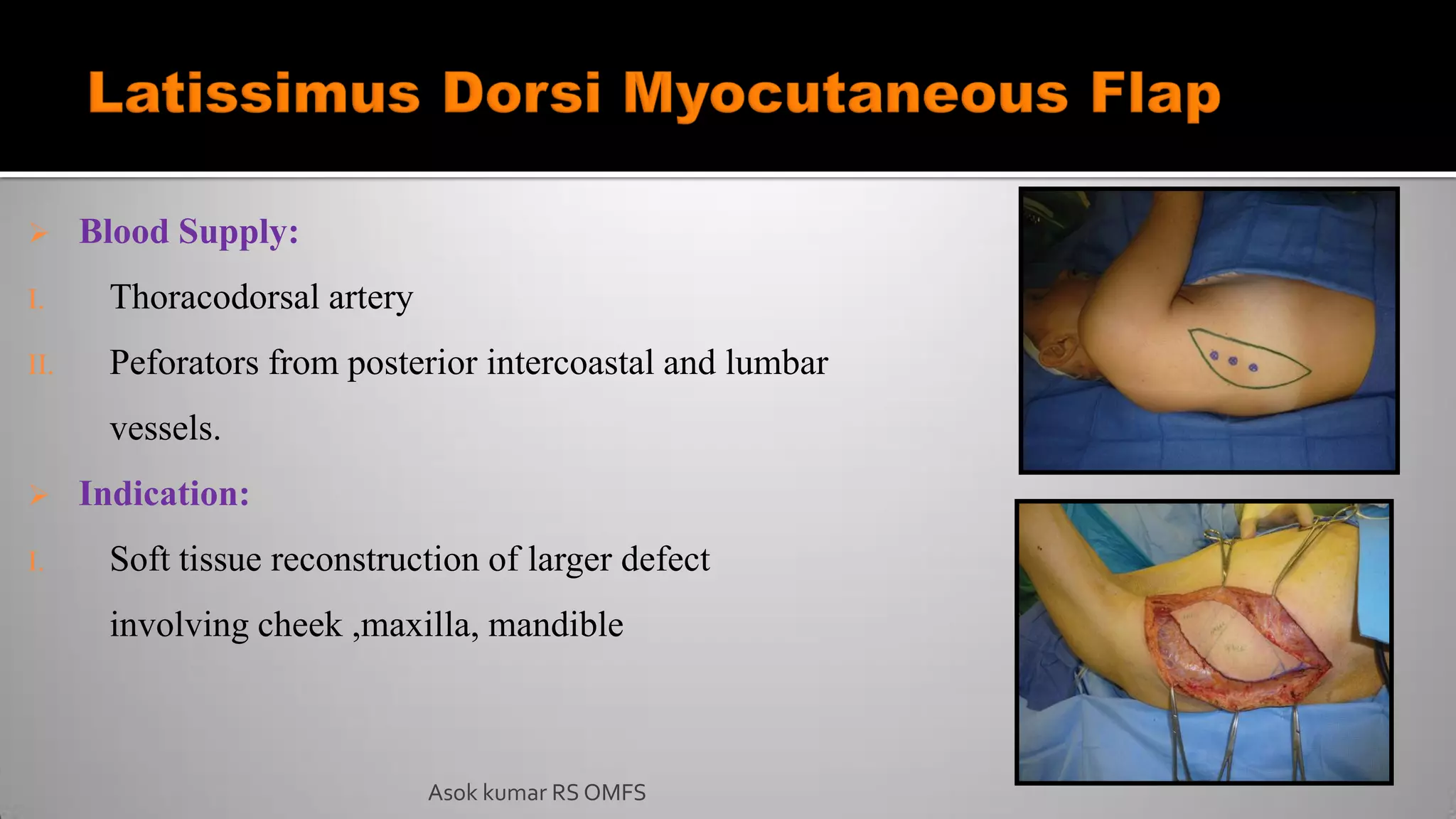  Blood Supply:
I. Thoracodorsal artery
II. Peforators from posterior intercoastal and lumbar
vessels.
 Indication:
I. Soft tissue reconstruction of larger defect
involving cheek ,maxilla, mandible
Asok kumar RS OMFS
 