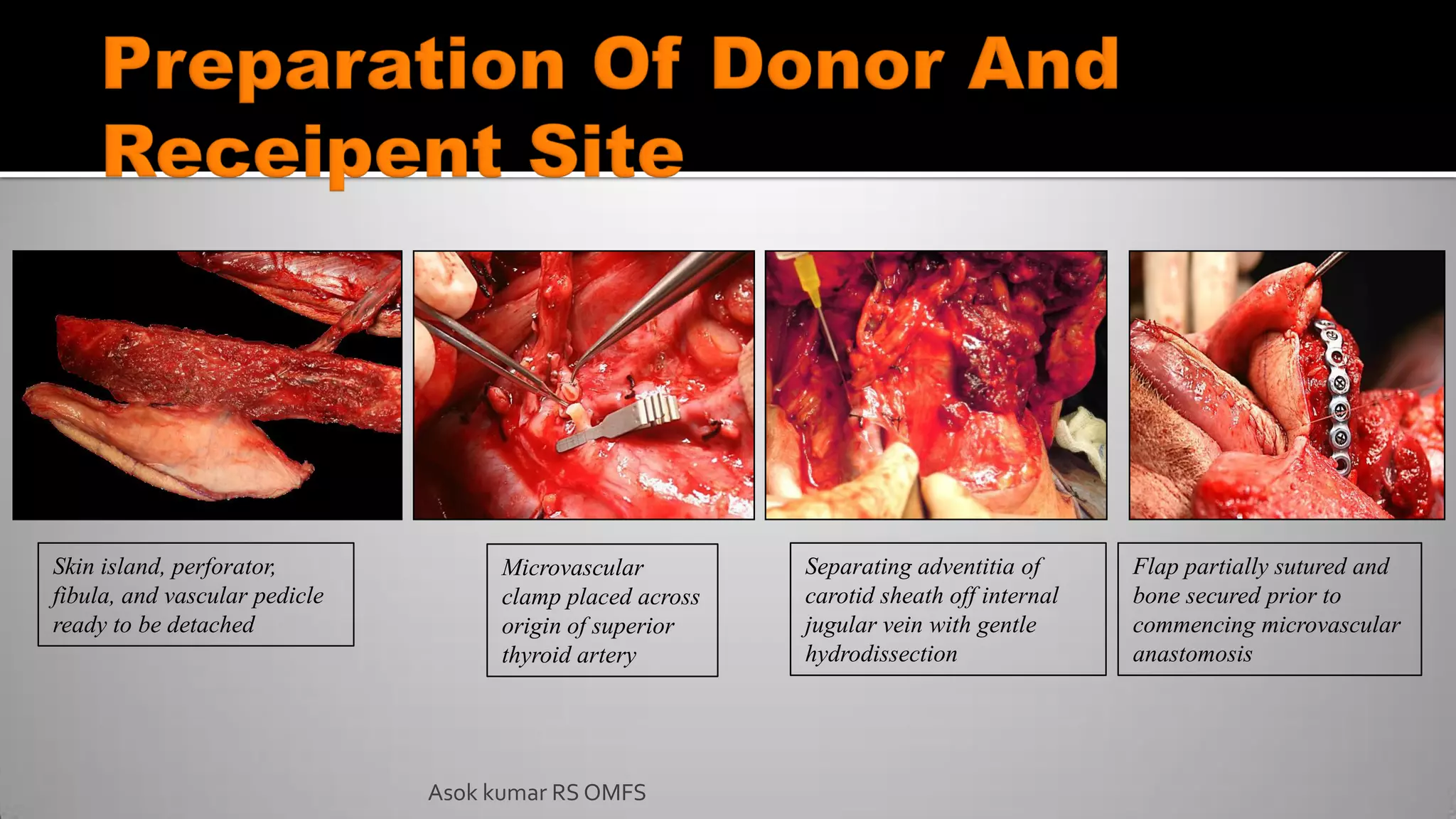 Asok kumar RS OMFS
Skin island, perforator,
fibula, and vascular pedicle
ready to be detached
Microvascular
clamp placed across
origin of superior
thyroid artery
Flap partially sutured and
bone secured prior to
commencing microvascular
anastomosis
Separating adventitia of
carotid sheath off internal
jugular vein with gentle
hydrodissection
 