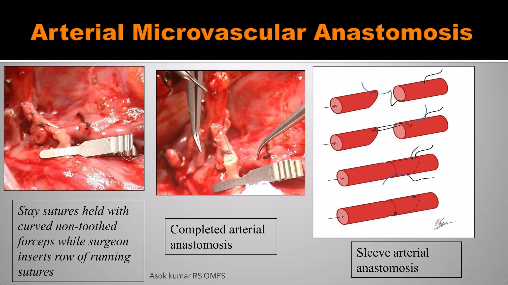 Sleeve arterial
anastomosis
Completed arterial
anastomosis
Stay sutures held with
curved non-toothed
forceps while surgeon
inserts row of running
sutures Asok kumar RS OMFS
 