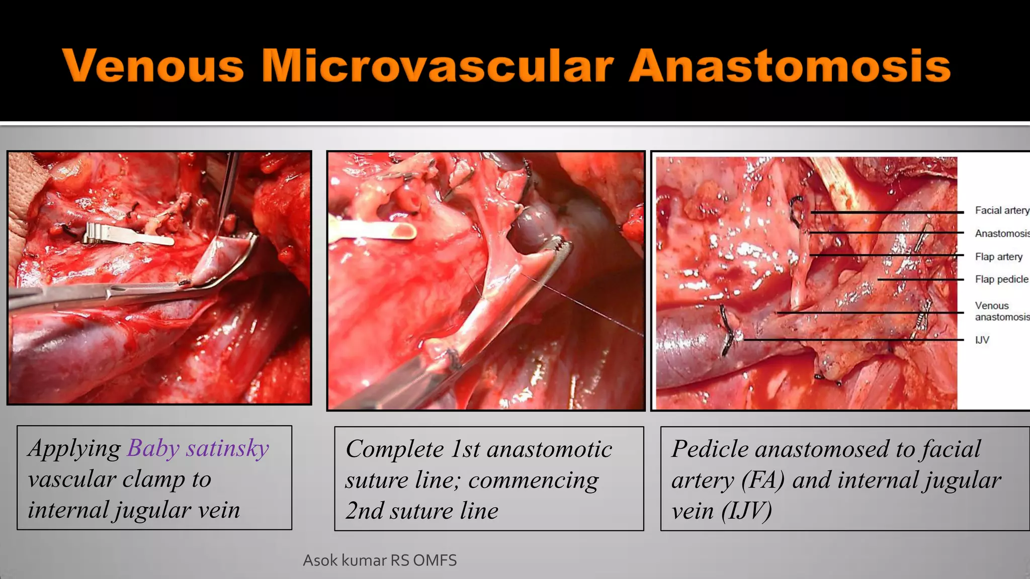 Complete 1st anastomotic
suture line; commencing
2nd suture line
Pedicle anastomosed to facial
artery (FA) and internal jugular
vein (IJV)
Applying Baby satinsky
vascular clamp to
internal jugular vein
Asok kumar RS OMFS
 