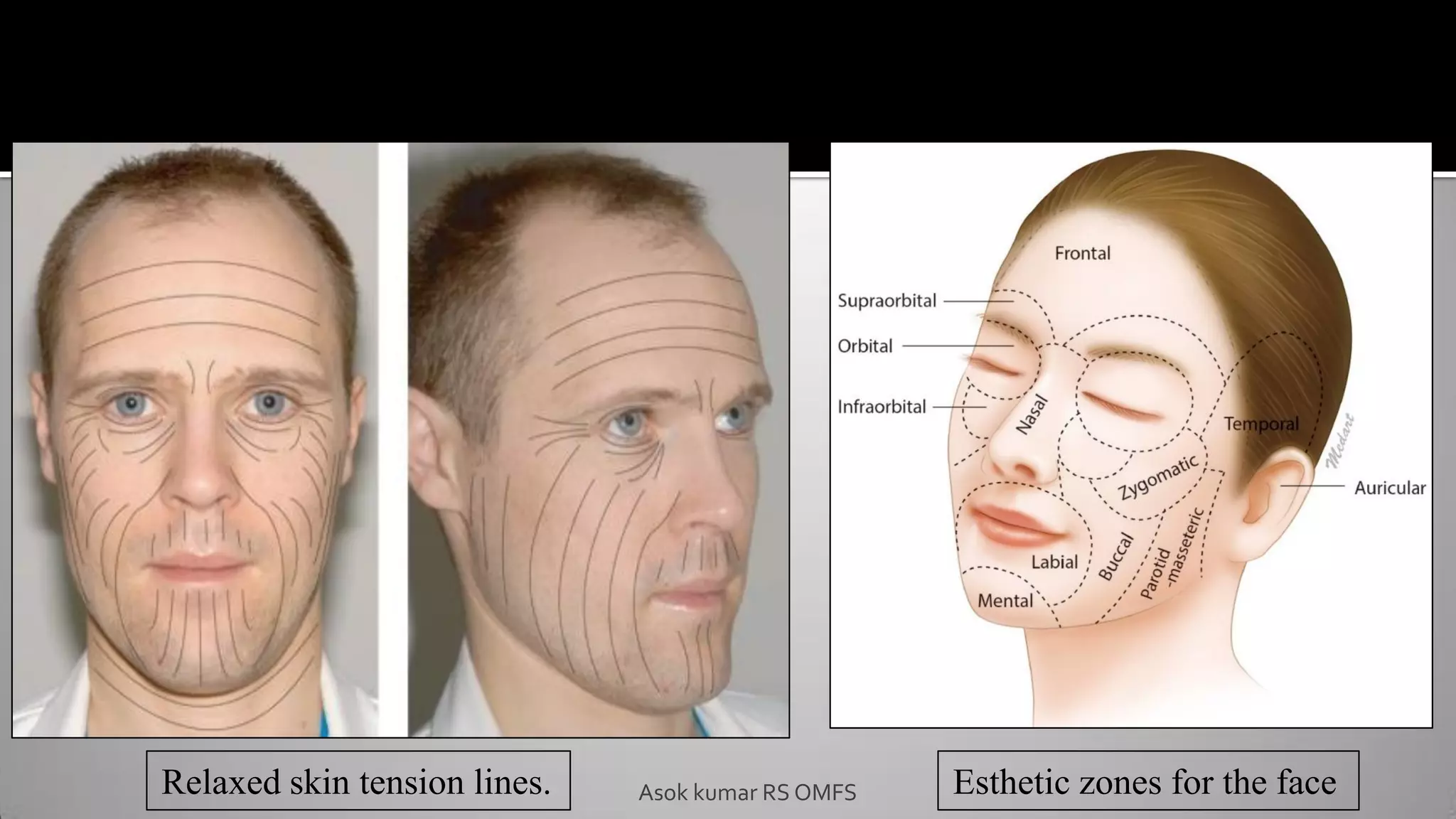 Relaxed skin tension lines. Esthetic zones for the face
Asok kumar RS OMFS
 