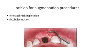 Comprehensive Guide to Soft-Tissue Flap Techniques for Implant ...