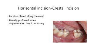 Comprehensive Guide to Soft-Tissue Flap Techniques for Implant ...