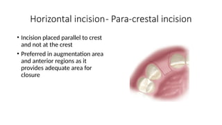 Comprehensive Guide to Soft-Tissue Flap Techniques for Implant ...