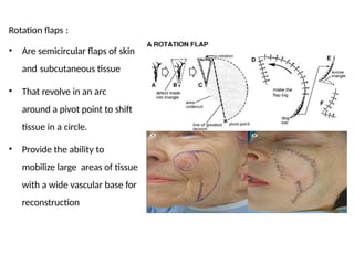 Single Rotation Flap Comprehensive Overview of Flaps and Their Classification in ...