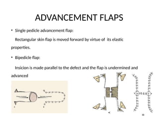 Pedicle Flaps Example Comprehensive Overview of Flaps and Their Classification in ...