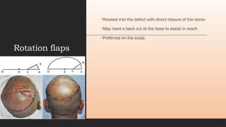 Comprehensive Overview of Flap Surgery: Anatomy, Classification, and ...